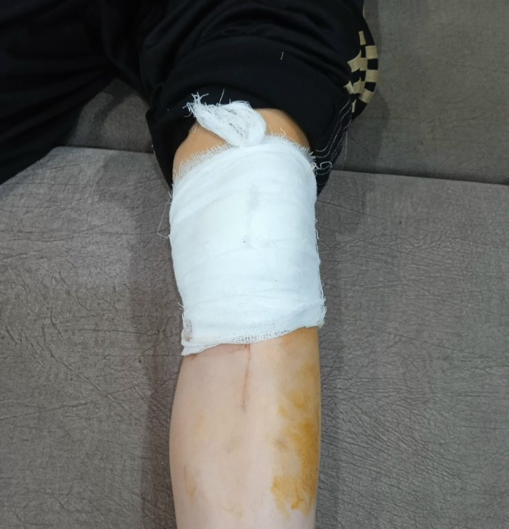 Прокуратура требует компенсацию для костромича, поранившего ногу на детской горке