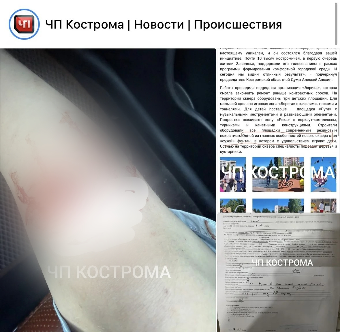 В Костроме в новом сквере в Заволжье пострадал ребенок